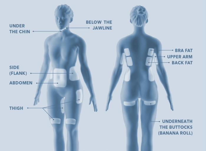Coolsculpting有3個機頭，適合做的部位有手臂、腰腹、大腿、副乳位、膝蓋上方、臀部下方。

