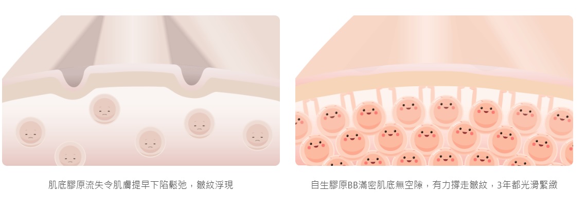 reenex叫醒肌底纖維母細胞工作，去除眼下細紋、額頭紋、虎紋、笑紋、抬頭紋、頸紋等