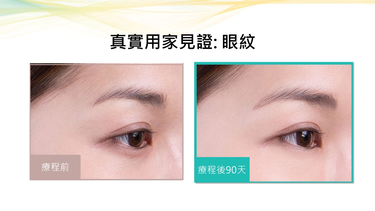 真實用家見證有效減淡眼紋，效果明顯