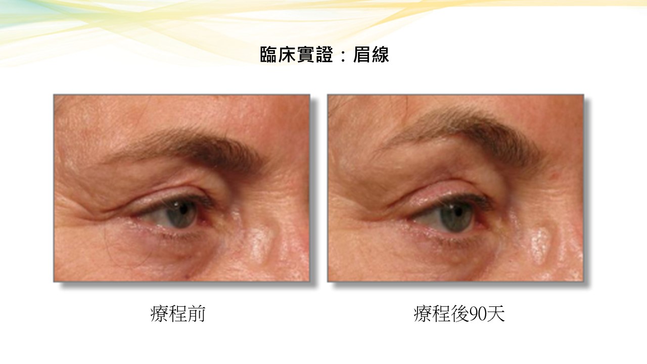 報告指86%用家眉眼線提升達1.9mm 