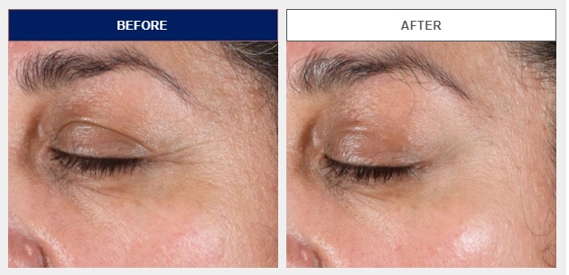 NEOSTRATA_全效塑顏緊緻精華_NEOSTRATA_SkinActive_Tri_Therapy_Lifting_Serum_肌底工程_去紋_抗皺_緊緻_提升_肌底工程師_皺紋_抗皺產品推介_抗皺精華推介_抗衰老_