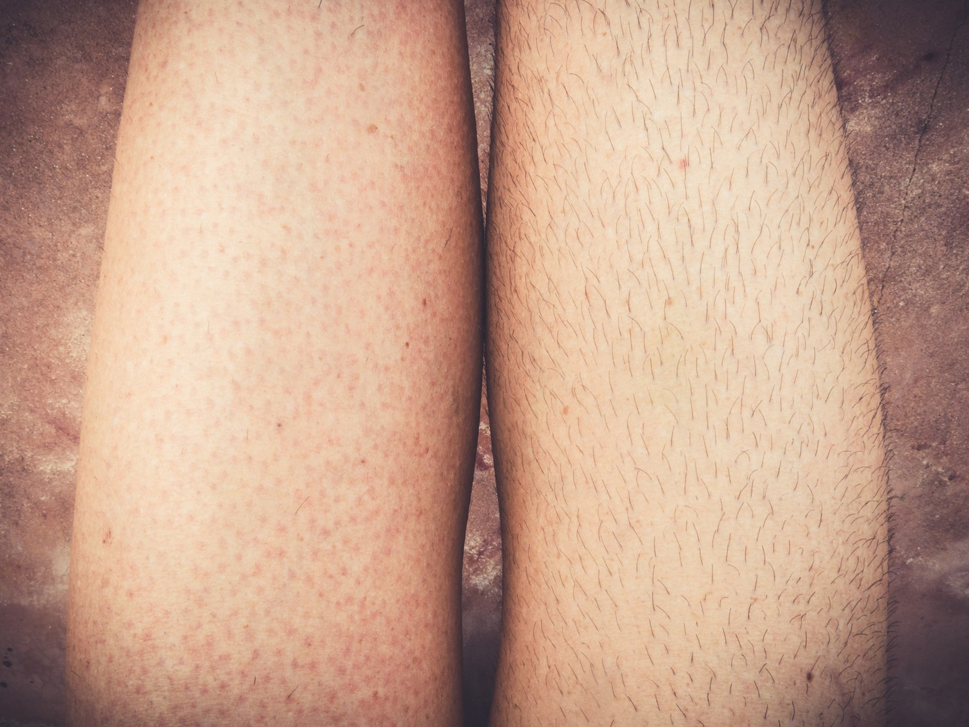 脫腳毛方法比較：腳毛會愈剃愈粗？最佳脫腳毛方法推薦