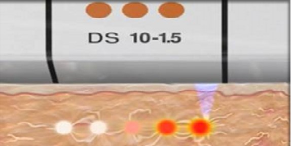  Ultherapy能準確聚集能量於3mm與4.5mm的「肌底彈力網」