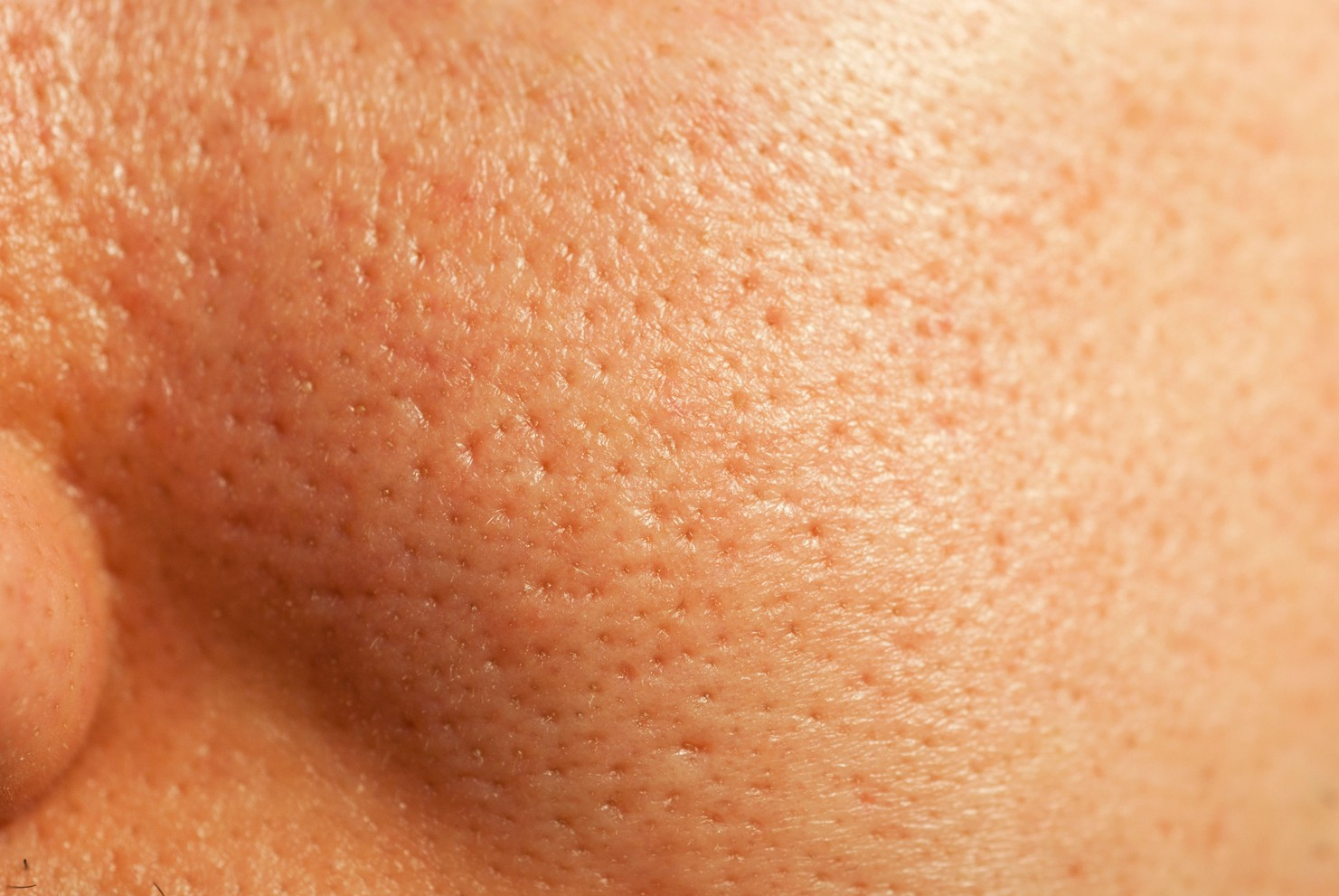 夏日肌膚問題2: 毛孔粗大肌膚需要:保濕 及 膠原蛋白。如您的肌膚在夏天經常出油，角質污垢會容易積聚，使毛孔被油脂撐大，因而令毛孔特別礙眼，除了要定期去角質外，更要為肌膚勤做保濕及增加肌膚膠原蛋白，因為皮膚乾燥會令紋理、毛孔變得粗大。另外毛孔粗大亦可以是膠原蛋白流失所致，令皮膚鬆弛下垂，毛孔變成水滴形。因此保濕+膠原蛋白的補充不可少。