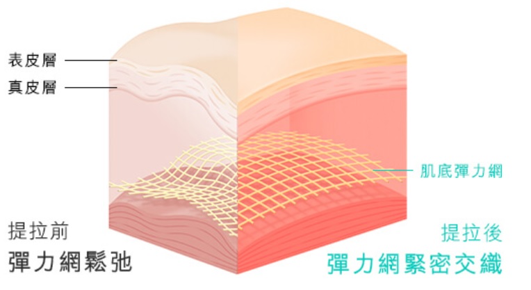 Ultherapy的賣點是以微聚焦超聲波提拉技術，產生超高熱能，以65°C聚焦超聲波高熱能，精準深入肌底4.5mm，即真皮層彈力網位置，是美容界現時能打入肌膚最深處的提拉療程。一次瘦程，全面輪廓提升，效果更持續一年！