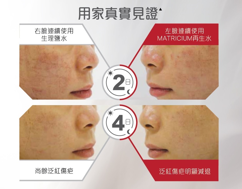 使用Bioderma Matricium，用後第2日及第4日，明顯見到使用Matricium後的左邊面泛紅問題大大消失，傷疤亦淡化了，非常適合療程後使用。