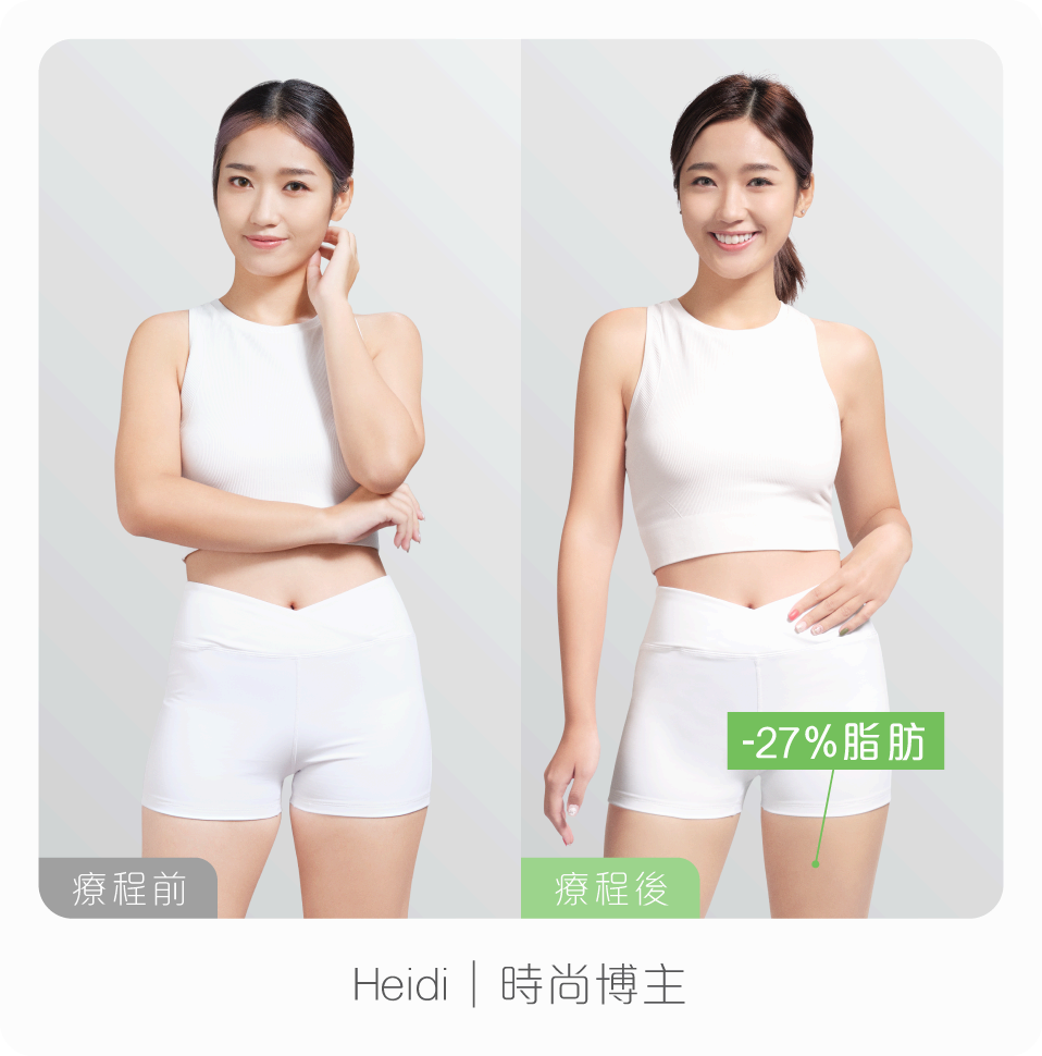 Debby – 3個小孩的媽媽   「完成elyze冷凍溶脂療程後，腰腹比產前更平坦緊緻！讓我更堅信做媽媽一樣可以靚，絕不必因忙碌而放棄自己。」 