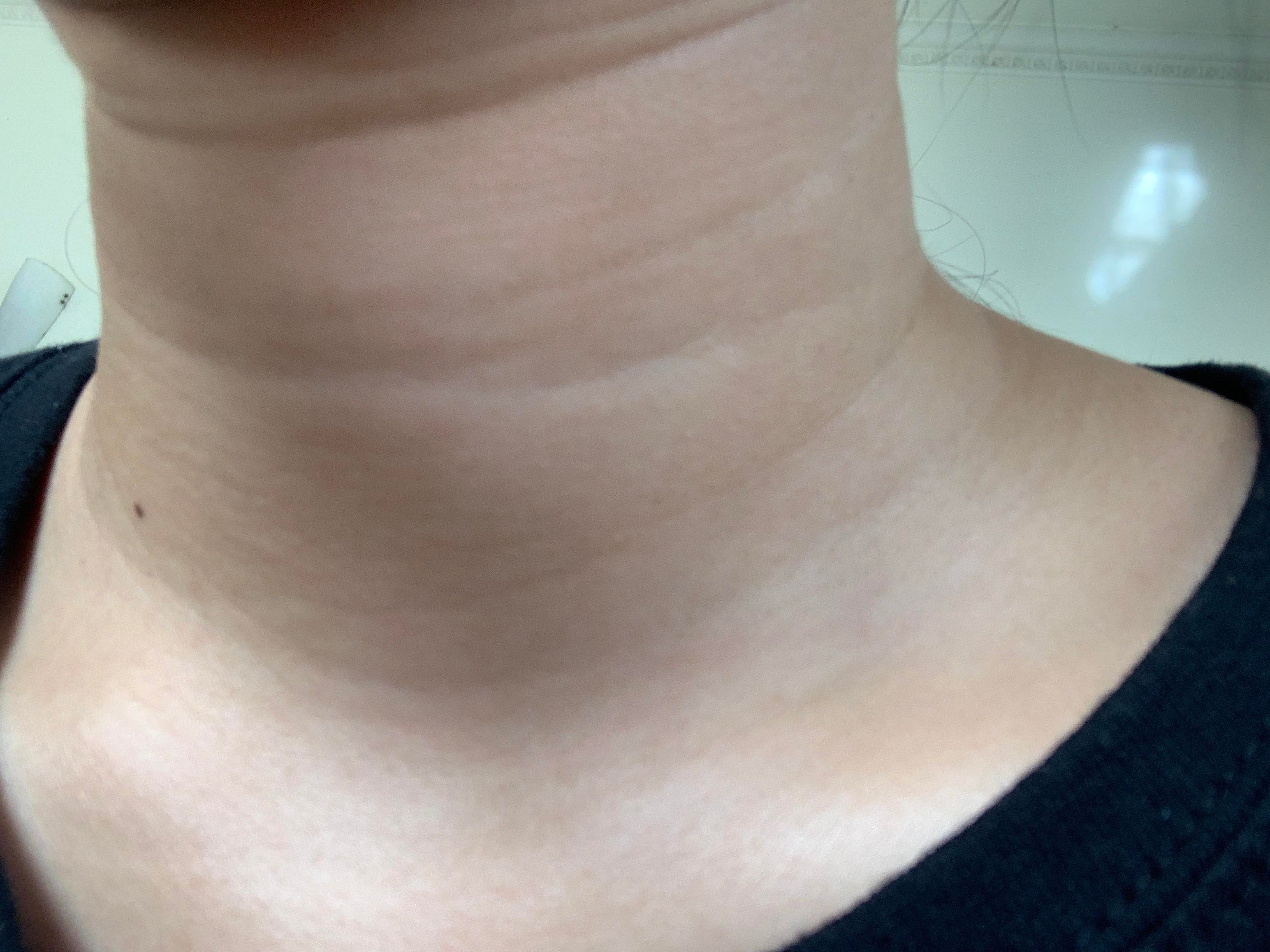玩手機出現醜女徵狀5:拿著手機經常低頭覆 WhatsApp、看 Facebook、IG，不但令面部易出皺紋，也令頸部皮膚經常出現皺褶，而形成頸紋，及使頸部皮膚鬆弛。